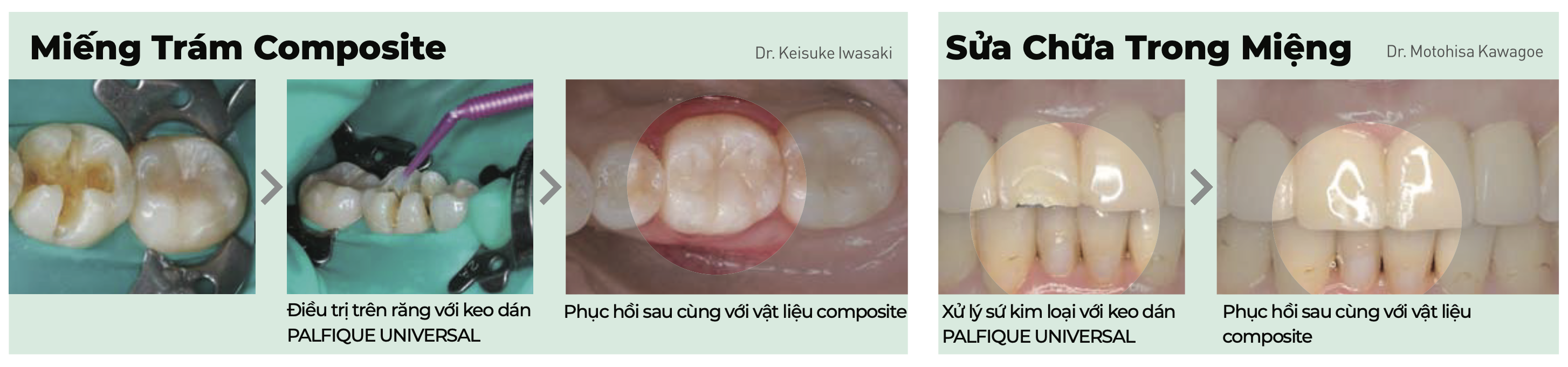 Keo dán đa năng Palfique Universal Bond Kit - Tokuyama